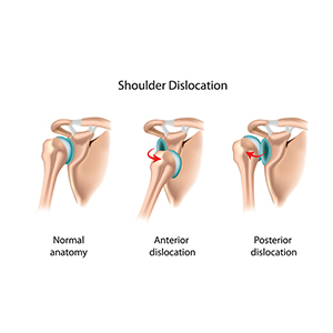 What is Shoulder Dislocation?